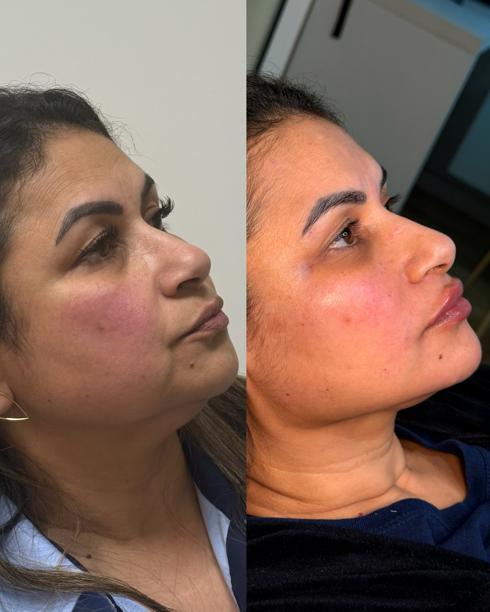 Harmonização Facial: por que tratar apenas uma região pode comprometer seus resultados?