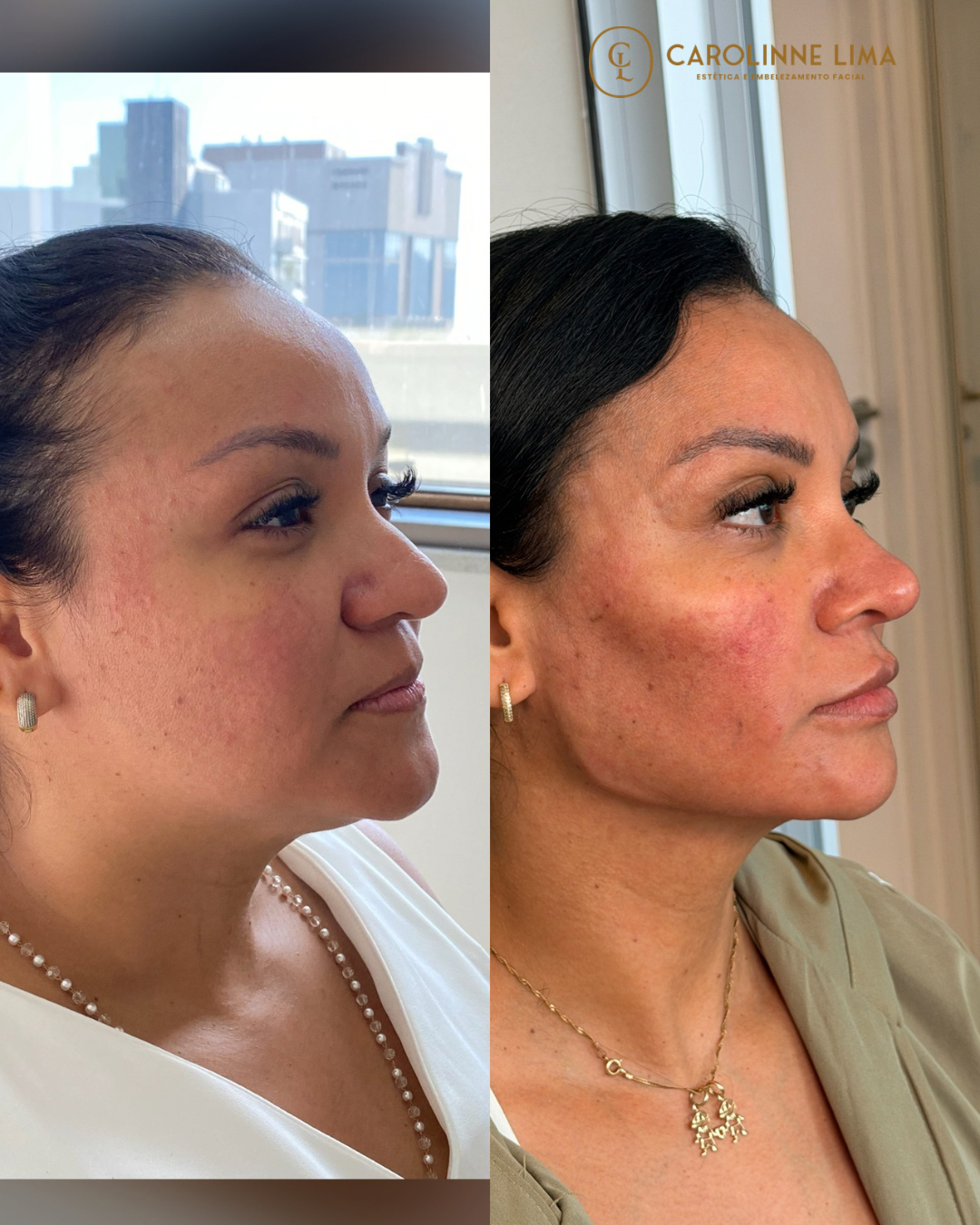 Protocolo 3Ps: Harmonização Facial Estratégica para Rejuvenescimento Natural em Mogi das Cruzes